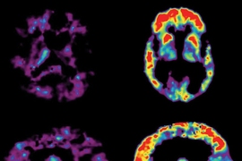 PET Scans Showing PiB Uptake in the brain of a cognitively healthy person (left) and in the brain of a person with AD (right).