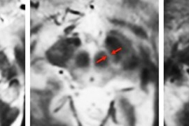 MIT neuroscientists imaged the substantia nigra in a young adult, left, an older adult, center, and a Parkinson’s patient, right. They found that the substantia nigra deteriorates in Parkinson’s patients.