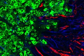 This image depicts the process of metastasis in a mouse tumor, where tumor cells (green) have helped to reorganize the collagen into aligned fibers (blue) that provide the structural support for motility. This helps the tumor cells to enter blood vessels (red), ultimately leading to the formation of metastases in other organs.
