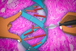 A new gene therapy technique being developed by researchers at MIT uses microRNAs — small noncoding RNA molecules that regulate gene expression — to control breast cancer metastasis.
