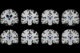 MIT researchers describe a machine-learning algorithm that can register brain scans and other 3-D images more than 1,000 times more quickly using novel learning techniques.