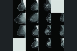 In training and testing, the model learns to map mammogram features with correct density ratings from human experts in four categories — fatty, scattered, heterogeneous, and dense. It achieved a 94 percent agreement among Massachusetts General Hospital radiologists over 10,000 mammograms. In this image, the model’s density predictions are in the four columns, left to right; the radiologists’...