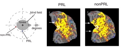 Left: A macular degeneration patient suffers vision loss in the central visual field of the retina (fovea) and uses a new fixation (PRL, preferred retinal locus) in the lower periphery for tasks such as reading. Visual stimuli were presented at the PRL and another peripheral location (nonPRL).
Middle and Right (fMRI scans): Central vision cortex (white circle) responds to both stimuli presented a...