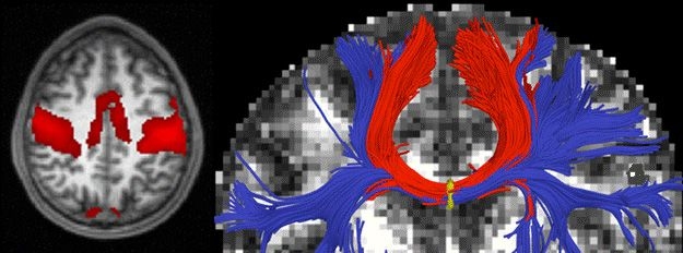 Left: A functional magnetic resonance imaging (MRI) scan with cortical regions strongly correlated with motor activity highlighted in red. Right: A diffusion MRI scan with white-matter bundles passing through the corpus callosum shown in blue and red.