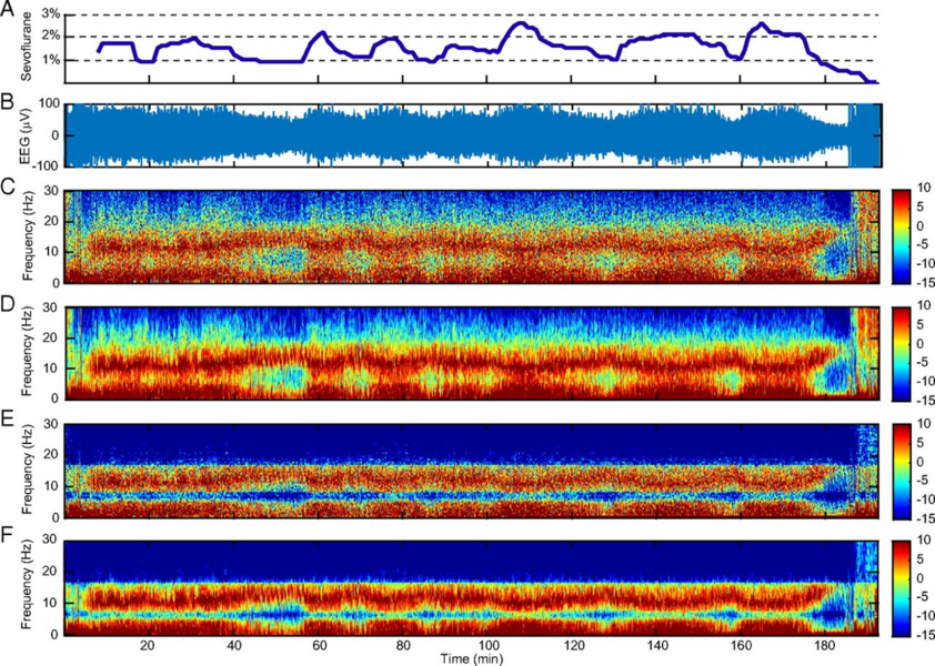 Using a novel analytical method they have developed, MIT researchers analyzed raw brain activity data (B). The spectrogram shows decreased noise and increased frequency resolution, or contrast (E and F) compared to standard spectral analysis methods (C and D).