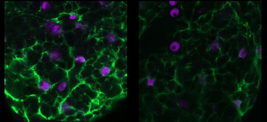A new study in a fruit fly model of epilepsy reveals how the genetic mutation involved leads to seizures: an imbalance of ions. A protein called sandman is supposed to manage levels of potassium ions. Here staining of cortex glia cells shows much less sandman (green) in the mutant flies (right) than in typical flies (left).
