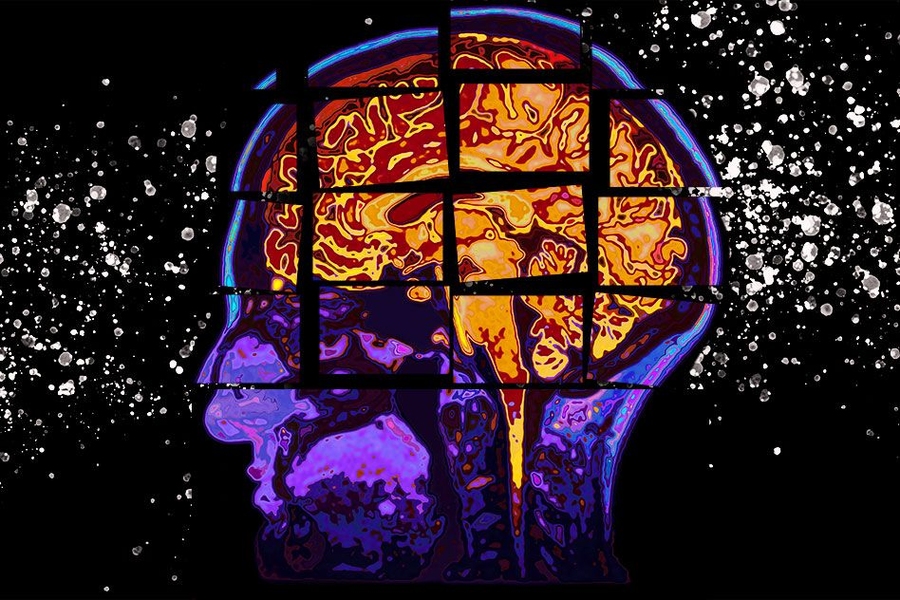 A model developed at MIT predicts the cognitive decline of patients at risk for Alzheimer’s disease by forecasting their cognition test scores up to two years in the future, which could help zero in on the right patients to select for clinical trials.