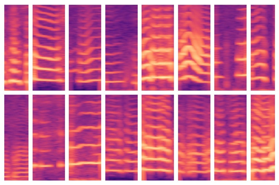 A new MIT-developed model automates a critical step in using AI for medical decision making, where experts usually identify important features in massive patient datasets by hand. The model was able to automatically identify voicing patterns of people with vocal cord nodules (shown here) and, in turn, use those features to predict which people do and don’t have the disorder.
