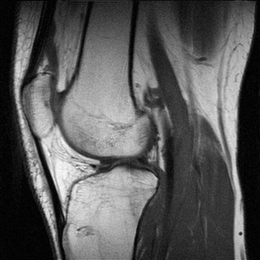 A sagittal MRI of the knee