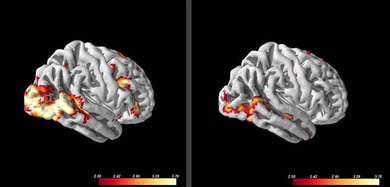 Social anxiety patients with more activity in visual processing areas, left, when viewing images of angry faces, responded better to subsequent cognitive behavioral therapy than patients with lower activity in those regions.