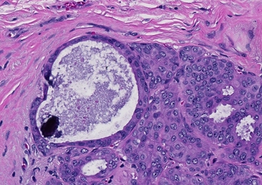 Photomicrograph of a microcalcification associated with breast cancer.