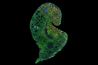 In this image of a growing mouse tumor, yellow fluorescence marks the presence of Lgr5+ cancer stem cells. Although Lgr5+ cells are only a minority of tumor cells, they are the source of all other tumor cells.