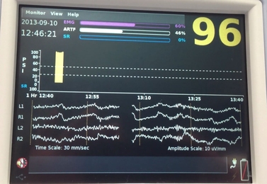 An operating room monitor includes EEG readings of the patient while under general anesthesia.
