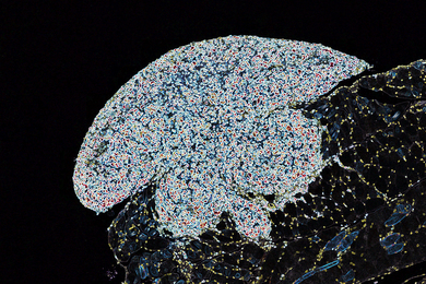 Microscope image of an ovarian tumor