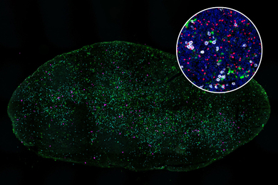 On a black background, an oval-shaped lymph node specimen has thousands of specks of light in green, white, and pink. An inset circle shows particles in blue, red, white, and green.