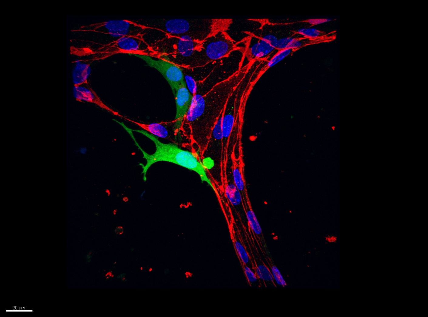 Medical Term For Tumor Arising From A Blood Vessel