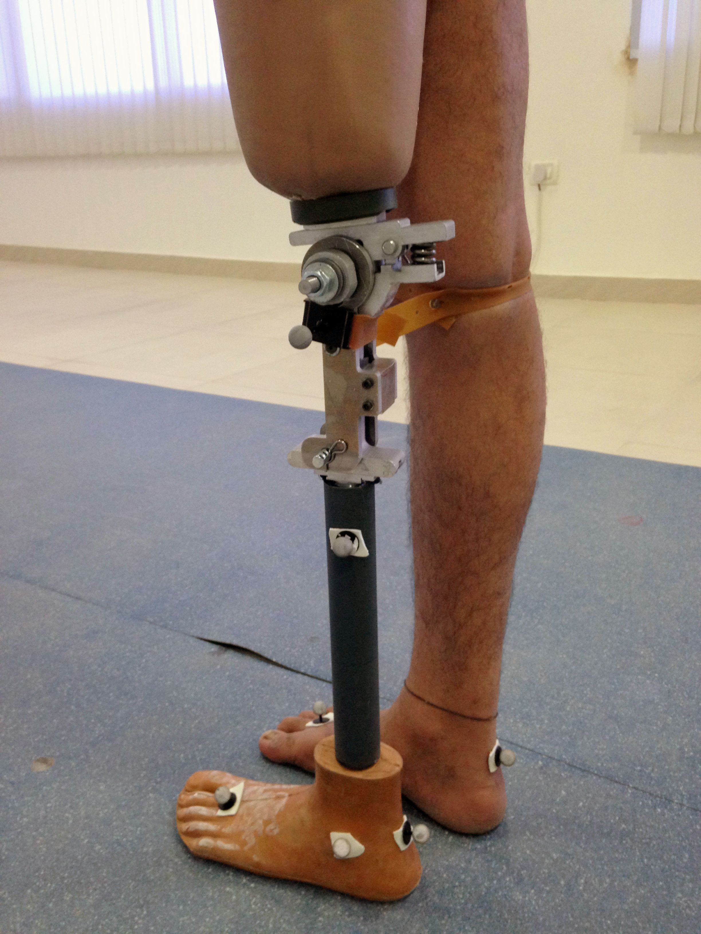 Very hig above knee amputation  Prosthetic leg, Prosthetics, Knee