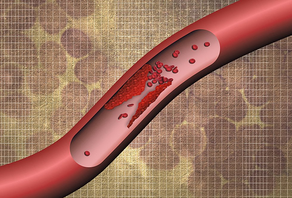 Finding Blood Clots Before They Wreak Havoc MIT News Massachusetts 