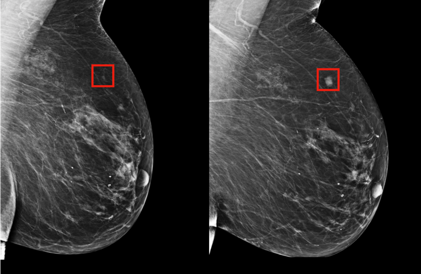 Using AI to predict breast cancer and personalize care | MIT News