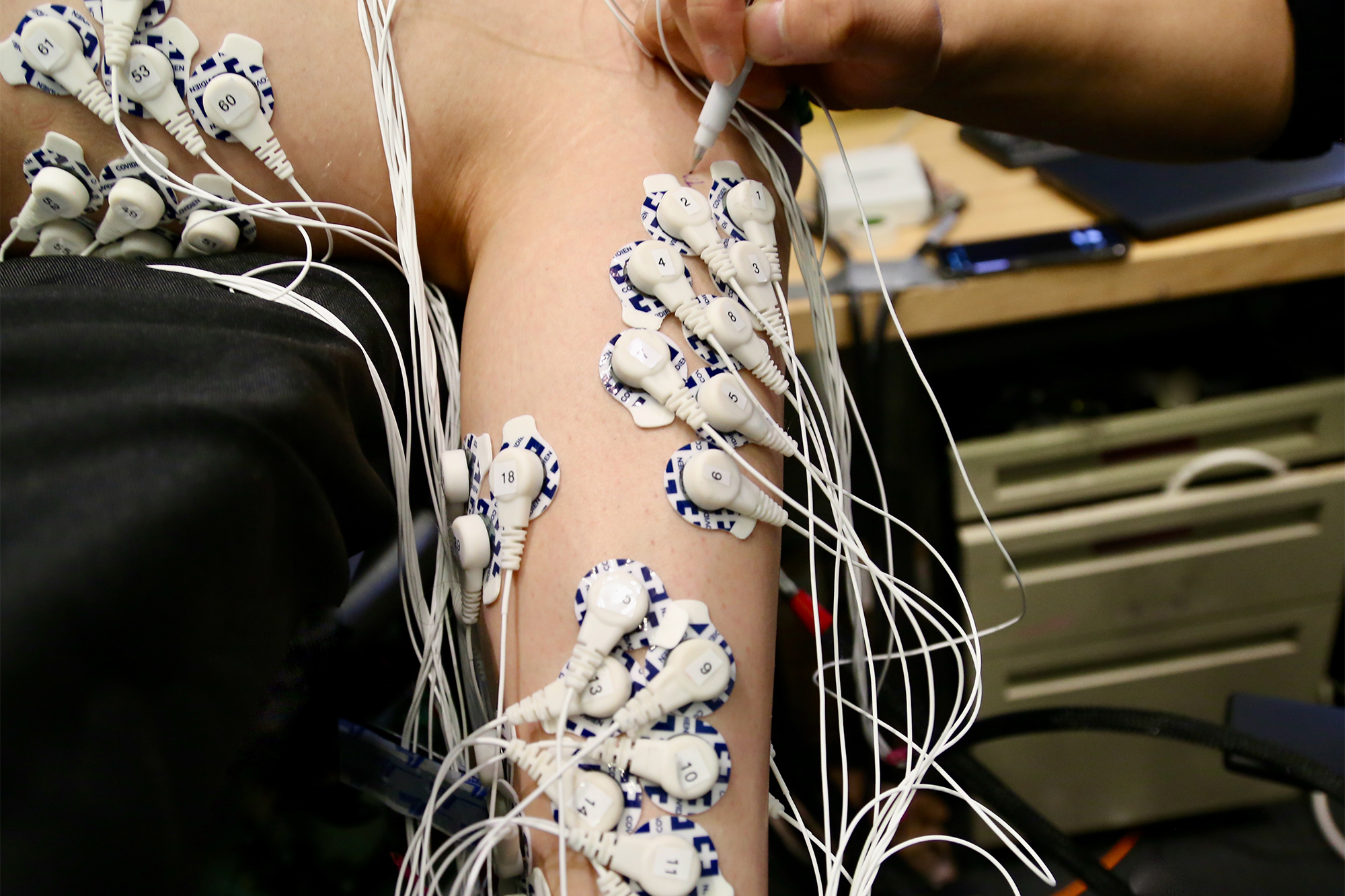 New surgery can enable better control of prosthetic limbs MIT News
