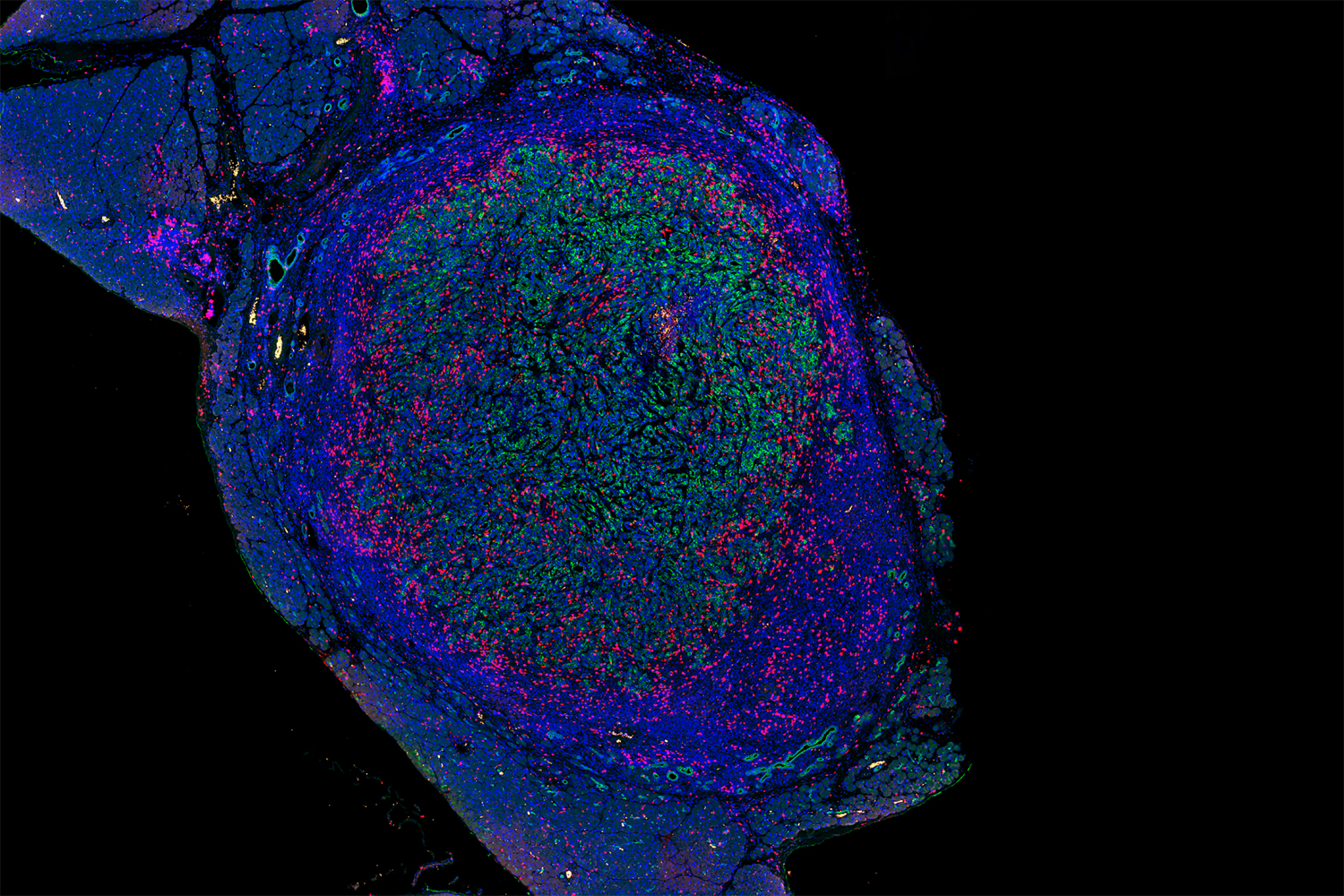 Новая терапия. Radioactive Gel Implant eliminates pancreatic tumors in 80% of Mice.