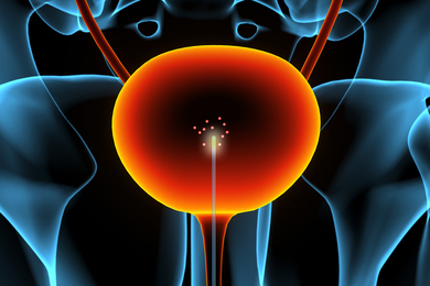 A bladder probe detecting cancer molecules