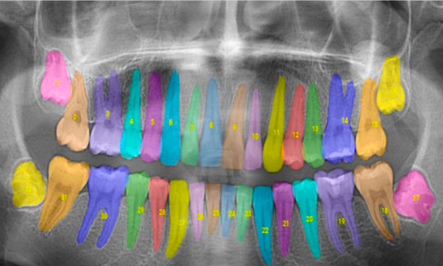 dental X ray with colored overlays for each tooth