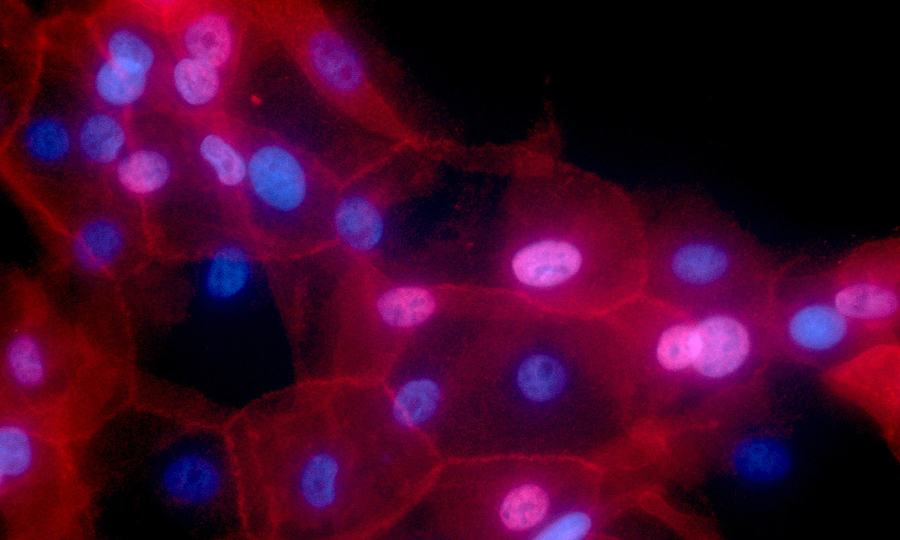 Human breast cancer cells