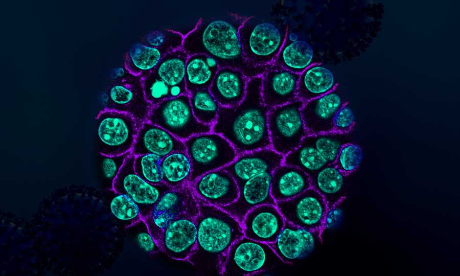 Colorized pancreatic cancer cells in teal encased in purple membranes.