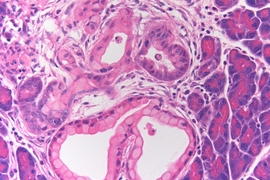 Seen here are two clusters of precancerous cells (lower half of image), which arose in pancreatic cells expressing the pdx1 protein and the cancer gene K-ras.