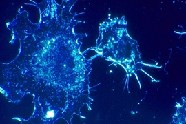 Cancer cells are shown here in culture from human connective tissue, illuminated by darkfield amplified contrast.