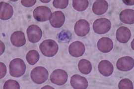 Giant platelets are shown here on a blood smear.