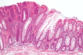 This micrograph shows a colorectal adenoma, a benign form of cancer that can turn malignant.