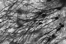 An image of Golgi stained neurons in the dentate gyrus of an epilepsy patient.