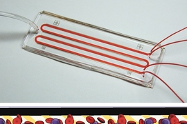 A microfluidic chip, like the one shown above, directly separates neutrophils from blood with ultrahigh purity and high efficiency without the need for cumbersome sample preparation. The chip works by mimicking the physiological process of 'cell rolling' where patterns of adhesive molecules are used to draw out neutrophils (blue) from a stream of blood (red) into a parallel buffer stream a...