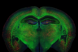 Beta-amyloid plaque deposits (red) disrupt mylelin (green) organization in the brain and activate microglia (orange), driving the inflammation, neurodegeneration, and cognitive disfunction associated with Alzheimer's disease.