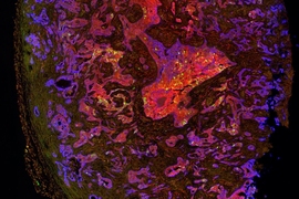 MIT researchers have found that lung tumors such as this one contain stem-cell-like cells that drive tumor aggression. In this image, those cells are tagged with a green fluorescent protein. 