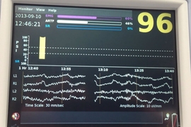 An operating room monitor includes EEG readings of the patient while under general anesthesia.