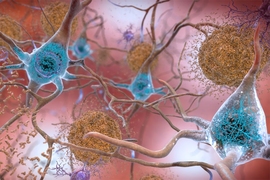 In the Alzheimer’s affected brain, abnormal levels of the beta-amyloid protein clump together to form plaques (seen in brown) that collect between neurons and disrupt cell function. Abnormal collections of the tau protein accumulate and form tangles (seen in blue) within neurons, harming synaptic communication between nerve cells.