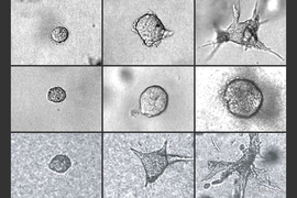 A tumor’s invasiveness depends on its water content and the stiffness of its exterior. In the top row, a tumor progresses normally toward an invasive profile. If water is drawn out of the same tumor (middle row), it is less invasive, compared to when the tumor is infused with water (bottom row), causing it to quickly burst and invade surrounding tissue.