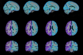 research papers on medical image processing With their model, researchers were able to generate on-demand brain scan templates of various ages (pictured) that can be used in medical-image analysis to guide disease diagnosis.
