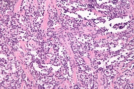 Alveolar rhabomyosarcoma, a soft tissue cancer