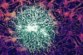 Tumor cells surrounded by endothelial cells