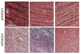 In a 3 by 2 array of panels we see a top row labeled "APOE3/3" of brain tissue with clear dark streaks. The lower row labeled "APOE3/4" shows brain tissue with much less dark streaking.