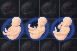Illustration shows three fetuses, each circled in blue, in different poses. A series of MRI images forms the background.