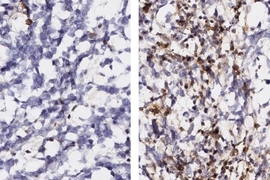 Side-by-side micrographs of a lacy blue latticework of brain tumor cells. The left image shows just a few brown dots scattered throughout and the right image shows brown dots densely covering more than half of the lattice.