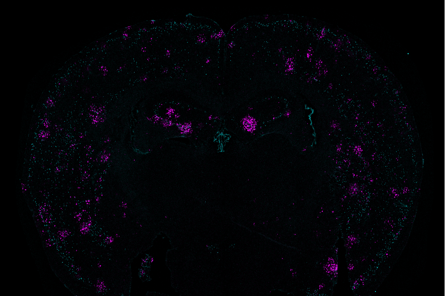 With fractured genomes, Alzheimer’s neurons call for help