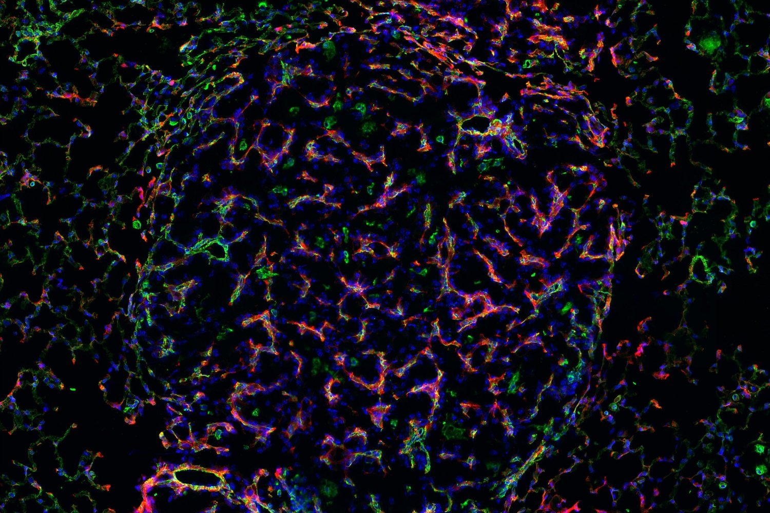 Nanosensors target enzymes to monitor and study cancer