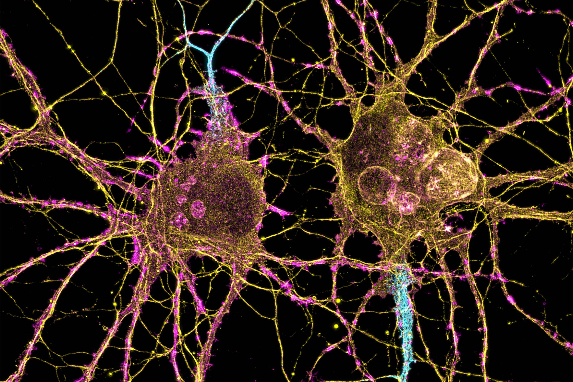 How Huntington’s Disease Affects Different Neurons ⋅ Entangled Cloud