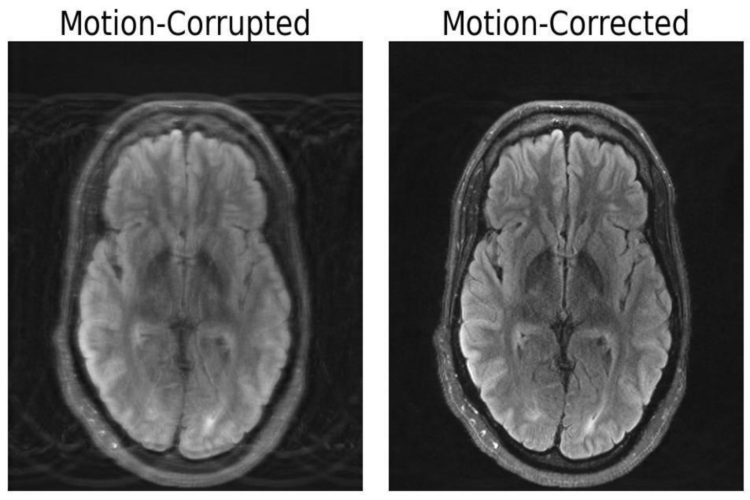 MIT researchers combine deep learning and physics to fix motion-corrupted MRI scans